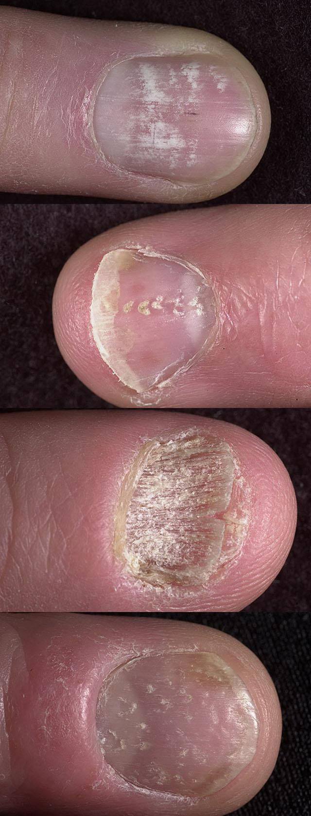 фото псориаза ногтей