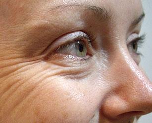 Методы восстановления кожи вокруг глаз