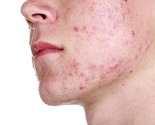 Заболевание кожи лица угри