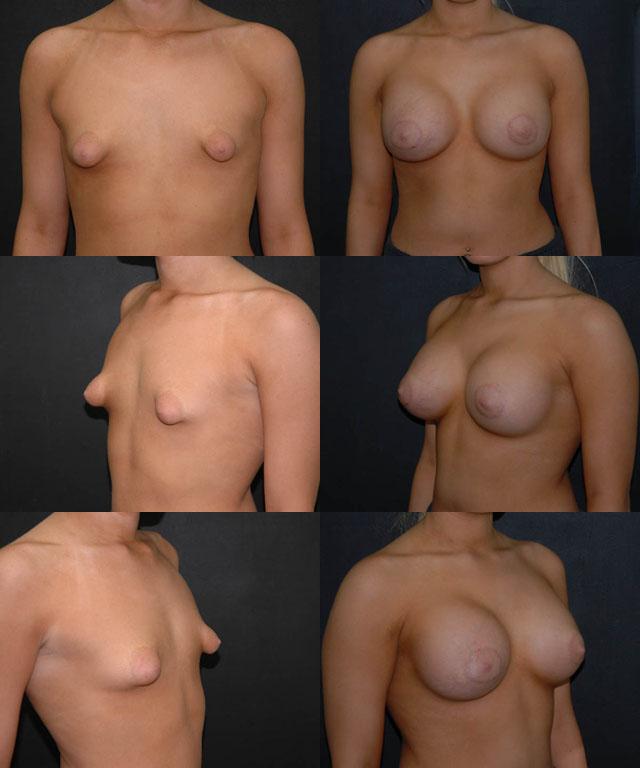 Увеличение тубулярной груди
