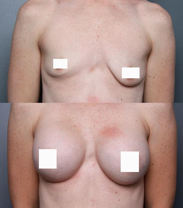 асимметрия груди
