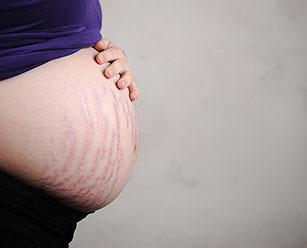 Профилактика от растяжек во время беременности