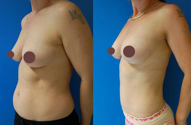 Коррекция формы грудных желез методом липофилинга