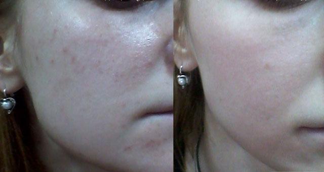 Атравматичную чистку кожи лица