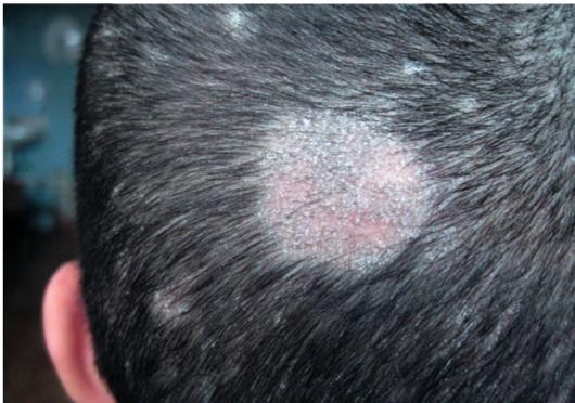 Гнойничковая болезнь кожи головы
