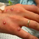 Что такое пиодермия: как развивается болезнь, эфективное лечение гнойных поражений кожи