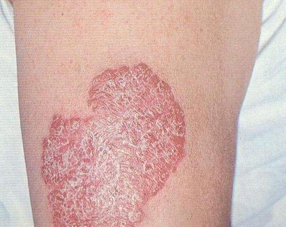Эксфолиативная разновидность люпоидного туберкулеза кожи