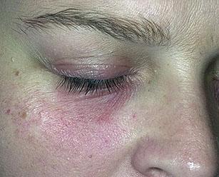 Отличия аллергического дерматита от контактного дерматита