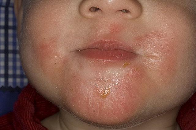 Младенческая фаза атопического дерматита