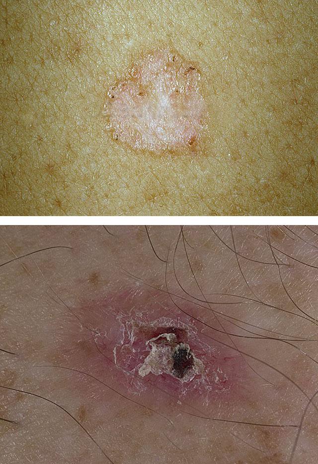 Базально клеточный рак кожи лица