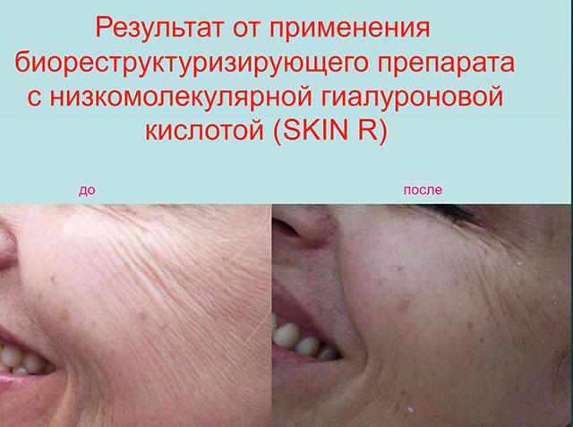 биоревитализация skin r
