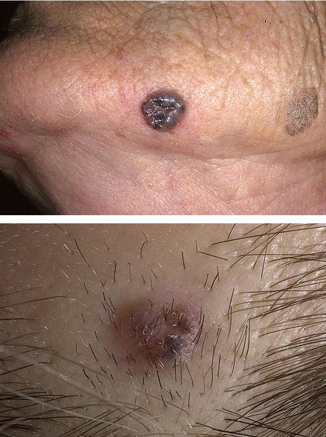 Клеточный рак кожи на лице