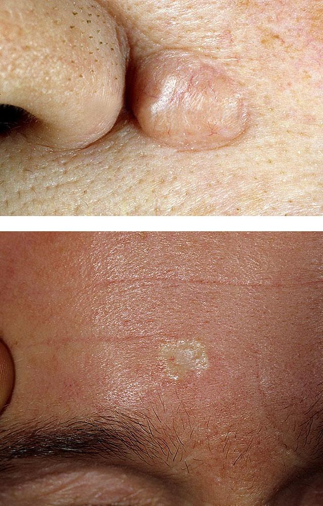 Базальноклеточный рак кожи: лечение и прогнозы при базальноклеточном раке кожи, базальноклеточная карцинома кожи фото