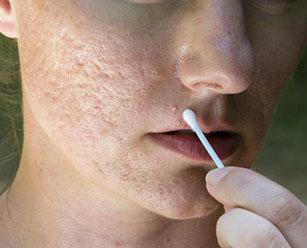 Как вылечить шрамы от угрей на лице