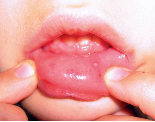 Вирусная пузырчатка полости рта