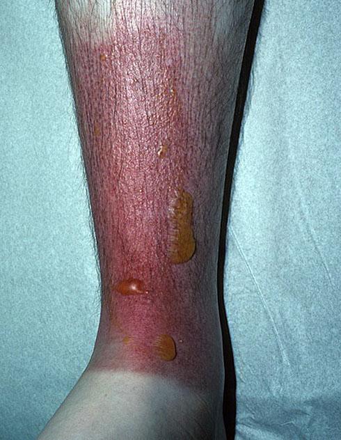 Буллезный пузырчатый дерматит что это такое лечение у детей и взрослых на руках и ногах