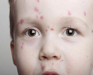 Вирусный дерматит у детей как передается