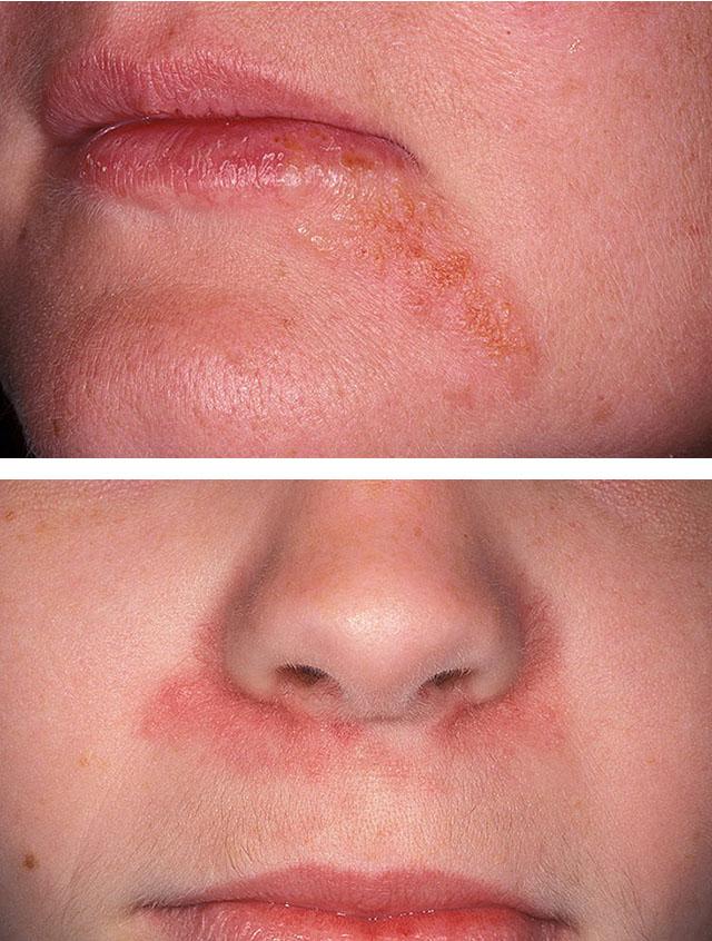 Периоральный дерматит на лице