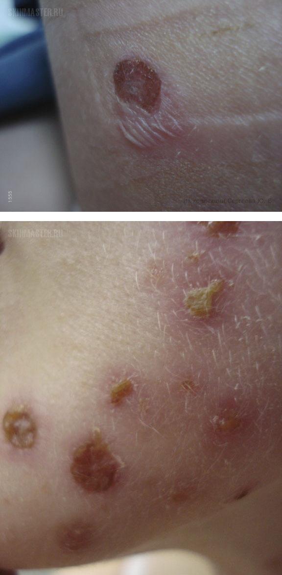 Буллезный пузырчатый дерматит что это такое лечение у детей и взрослых на руках и ногах