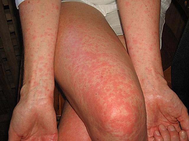 Инфекционный дерматит у детей заразен