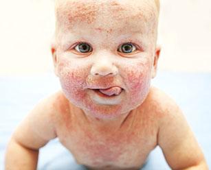 Мокнет кожа при атопическом дерматите