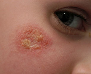 Экссудативный дерматит у детей