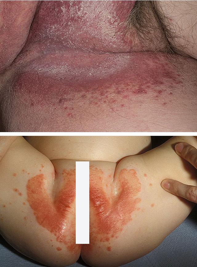 Детские дерматиты вызванные грибком thumbnail