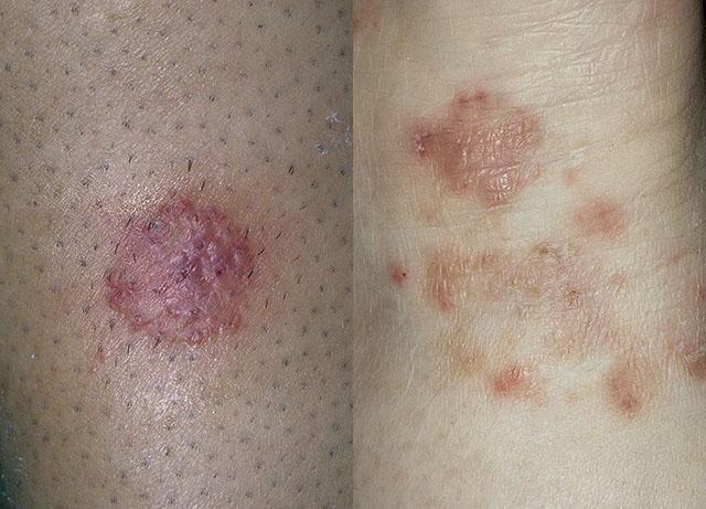 Грибок на коже на фоне атопического дерматита