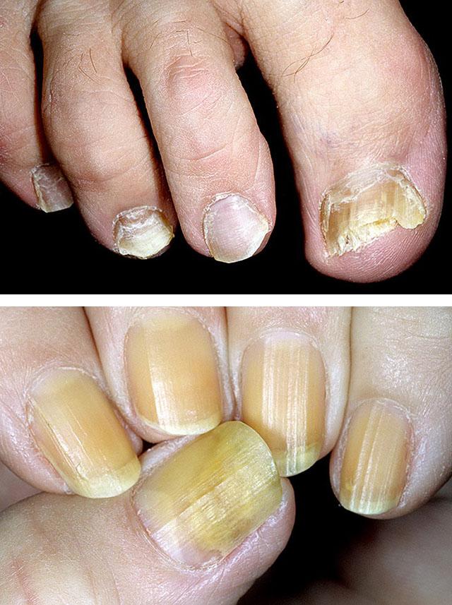Атрофия ногтей на ногах лечение thumbnail