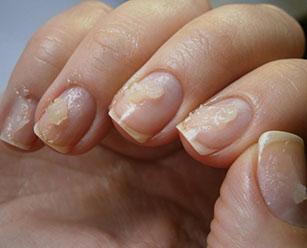 Травма матрикса ногтя - Все про грибок