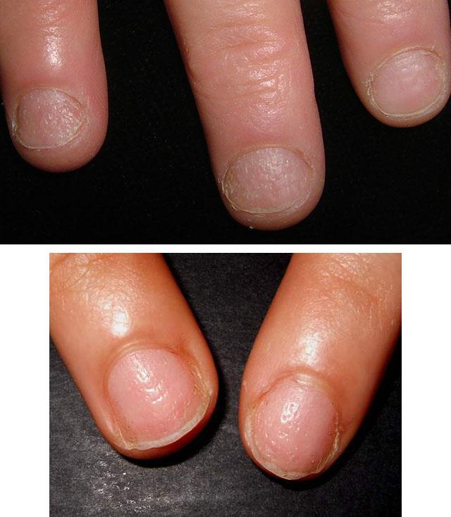 Как вылечить атрофию ногтей