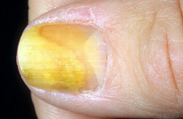 Онихолизис болезнь ногтей от чего она