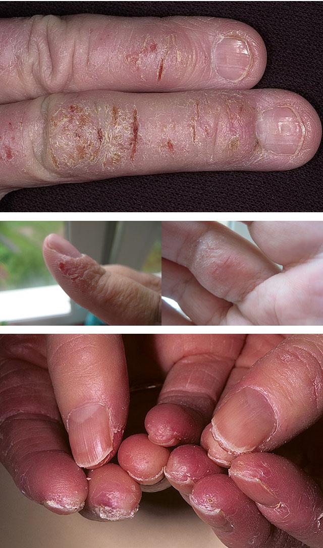 На пальцах рук трескается кожа как вылечить thumbnail