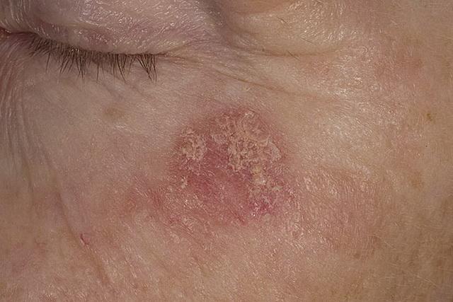 Предраковое заболевание кожи лица
