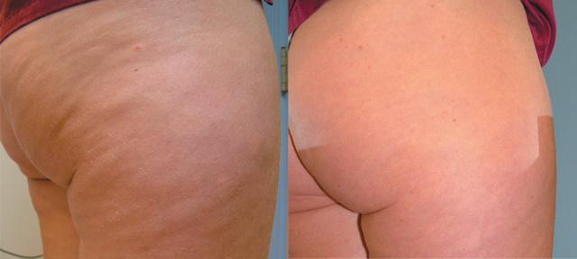 Результат до и после косметических процедур от целлюлита