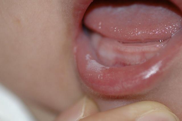 Ограниченный предраковый гиперкератоз кожи красной каймы губ
