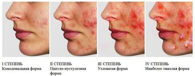 Как называется угревая сыпь на лице