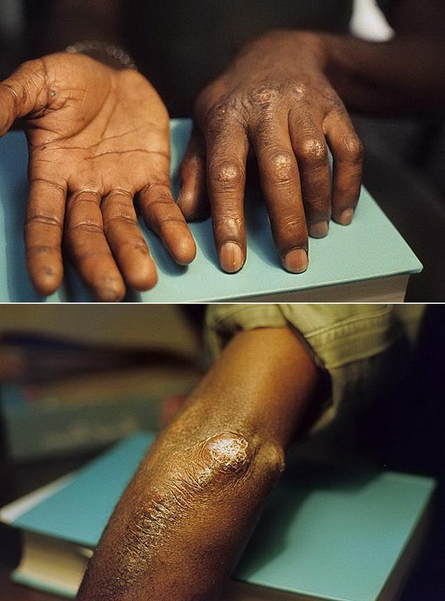 Кальциноз кожи лица лечение