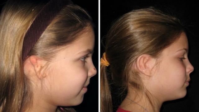 Отсутствие ушной раковины генетический синдром