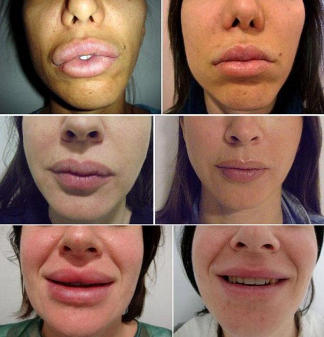 Фото до и после пластической операции по удалению биополимерного геля из губ