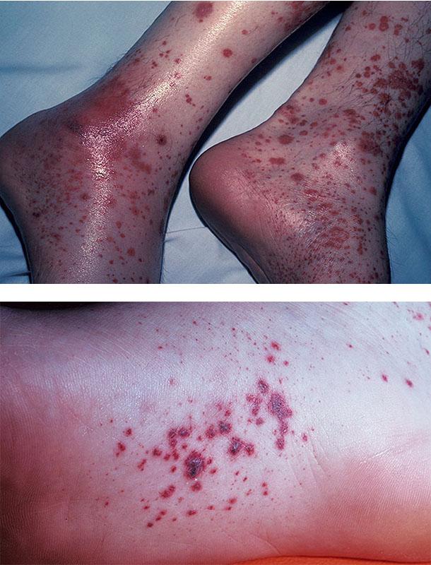 Заболевания сосудов проявления на коже