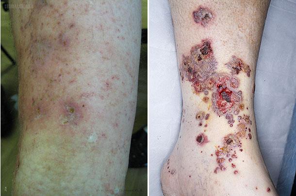 Основы наружной терапии болезней кожи васкулиты кожи