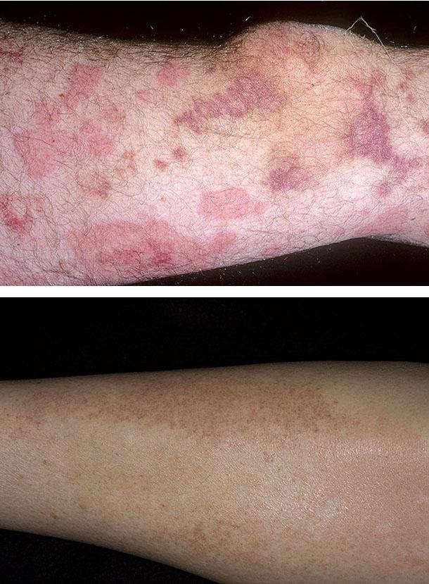 Основы наружной терапии болезней кожи васкулиты кожи