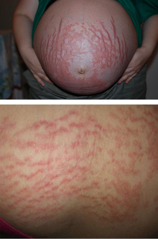 Покраснение и зуд кожи лица во время беременности