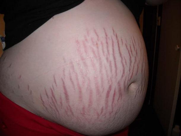 Сухая кожа при беременности чешется