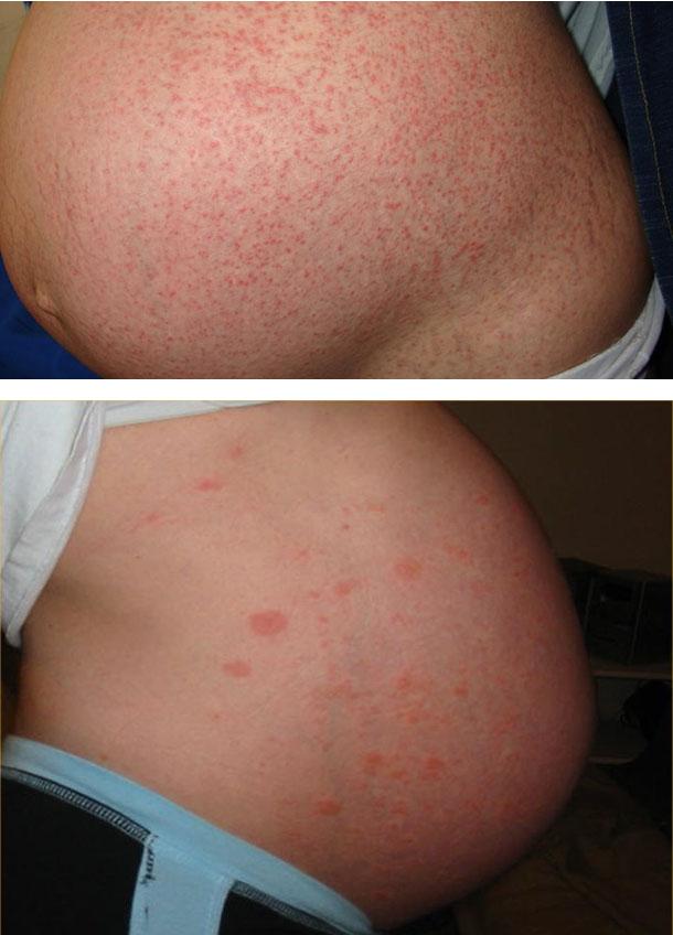 Покраснение кожи лица и шелушение при беременности