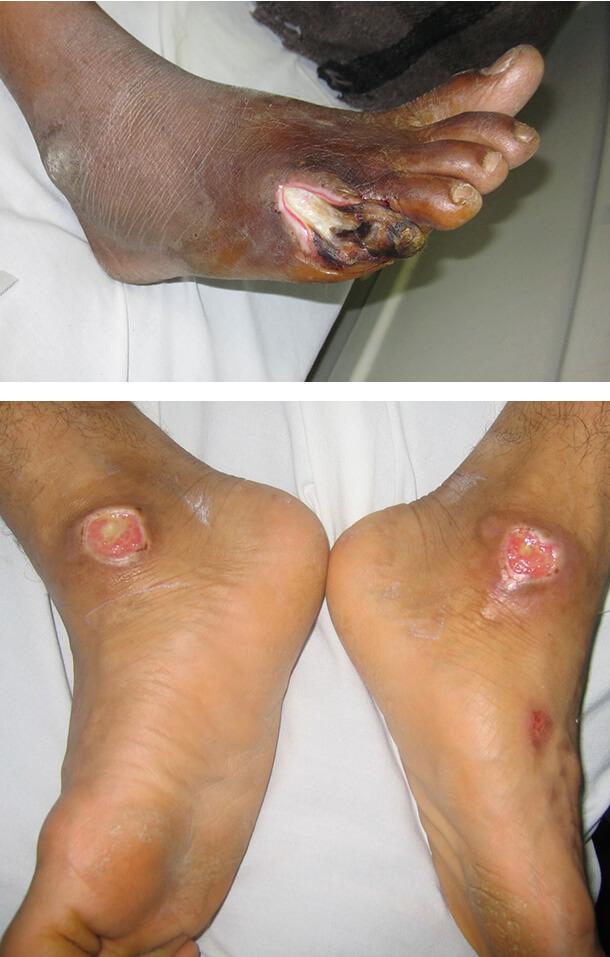 Проявления диабета на коже ног