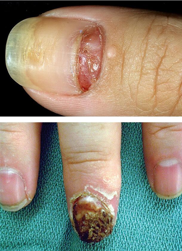 Рак ногтей на пальцах руки