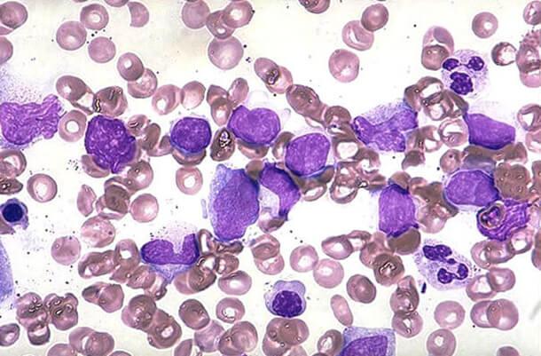 Анализ крови на клетки сезари