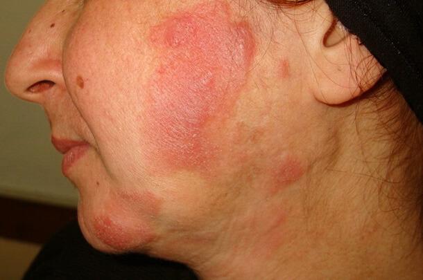 Грибовидный микоз кожи симптомы и методы лечения